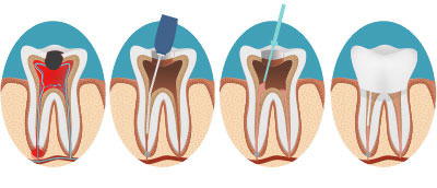 root-canal-treatment